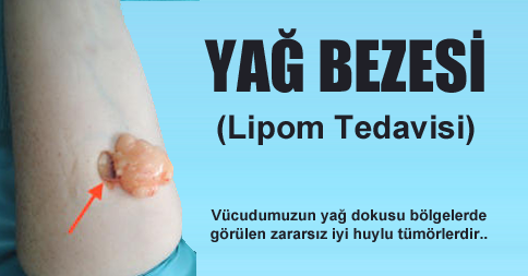 lipom yağ bezesi