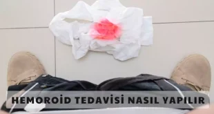 basur tedavisi