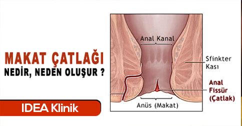 makat çatlağı tedavisi